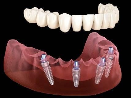 ایمپلنت یا کاشت دندان عالی کدام است؟