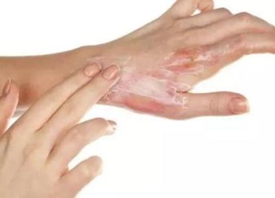 سوختگی پوست را در خانه درمان کنید